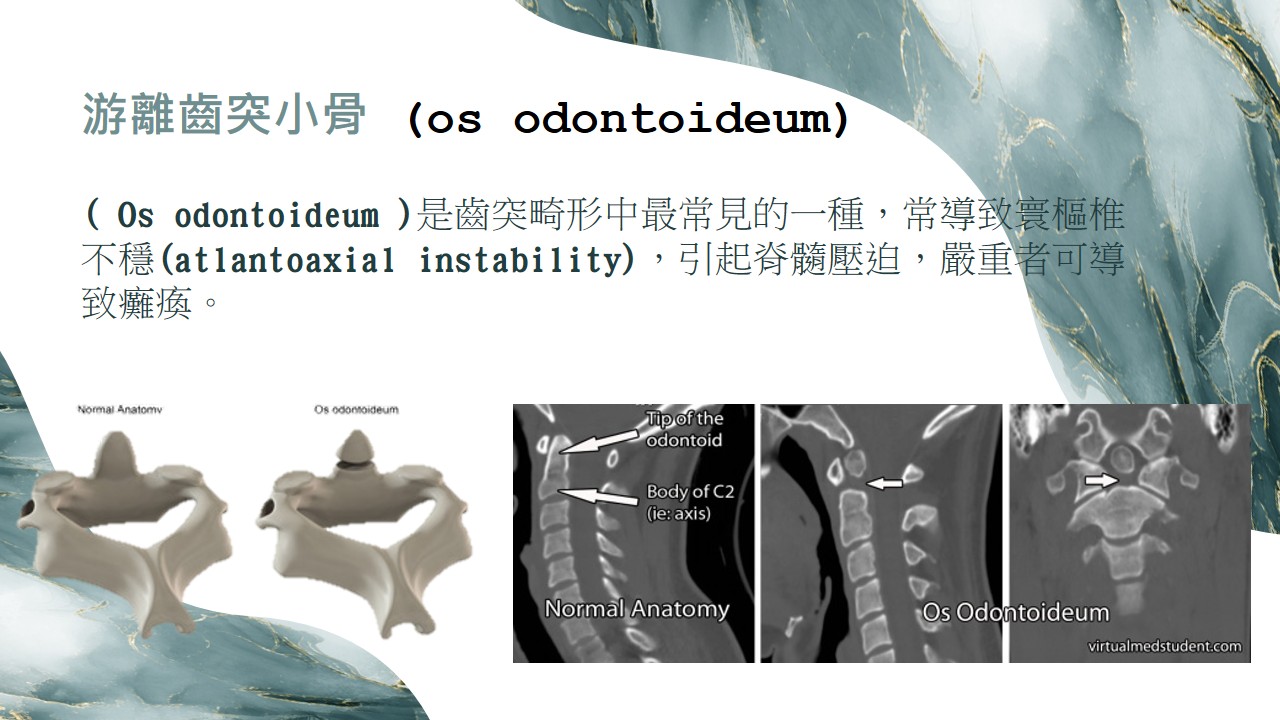 Os odontoideum A 示意圖